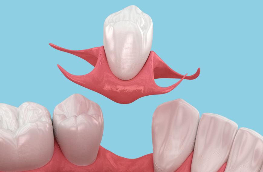 How Dental Implants Eliminate Speech Impediments Caused by Missing Molars and Posterior Teeth