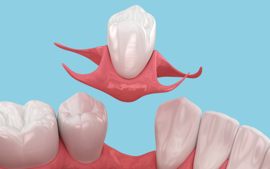 How Dental Implants Eliminate Speech Impediments Caused by Missing Molars and Posterior Teeth
